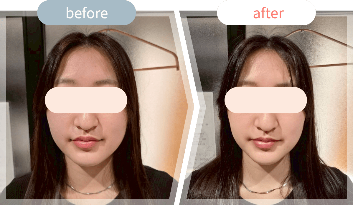 施術前後の顔写真